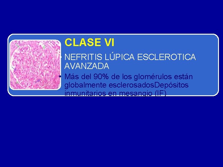 CLASE VI • NEFRITIS LÚPICA ESCLEROTICA AVANZADA • Más del 90% de los glomérulos