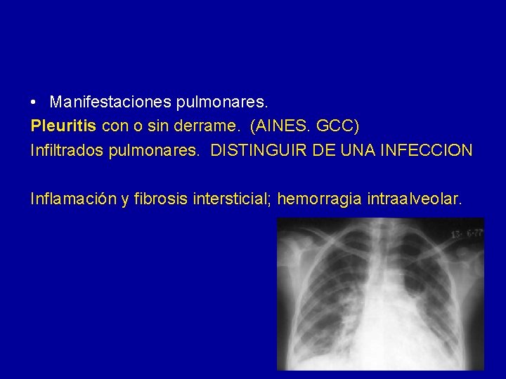  • Manifestaciones pulmonares. Pleuritis con o sin derrame. (AINES. GCC) Infiltrados pulmonares. DISTINGUIR