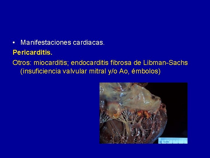  • Manifestaciones cardiacas. Pericarditis. Otros: miocarditis; endocarditis fibrosa de Libman-Sachs (insuficiencia valvular mitral