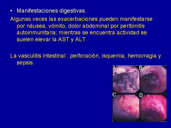  • Manifestaciones digestivas. Algunas veces las exacerbaciones pueden manifestarse por náusea, vómito, dolor