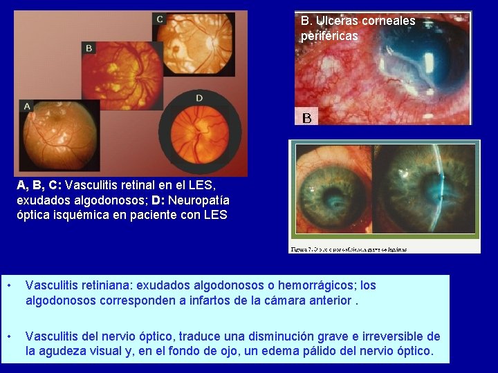 B. Ulceras corneales periféricas A, B, C: Vasculitis retinal en el LES, exudados algodonosos;