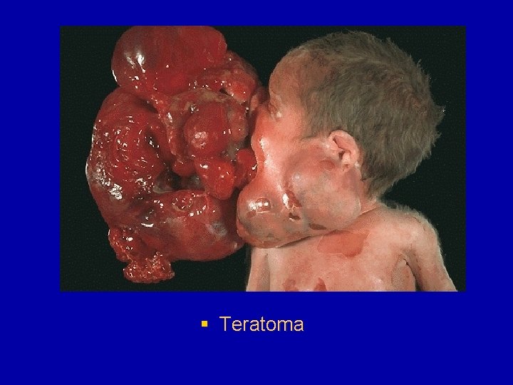 § Teratoma 