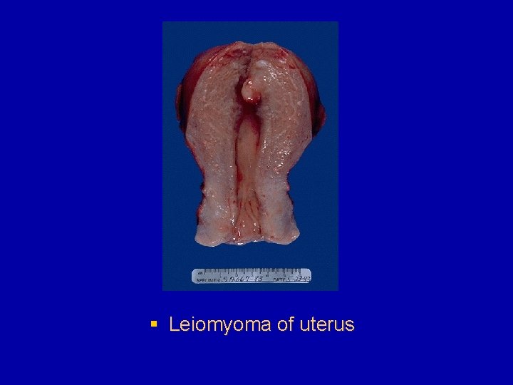 § Leiomyoma of uterus 