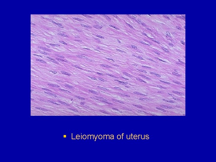 § Leiomyoma of uterus 