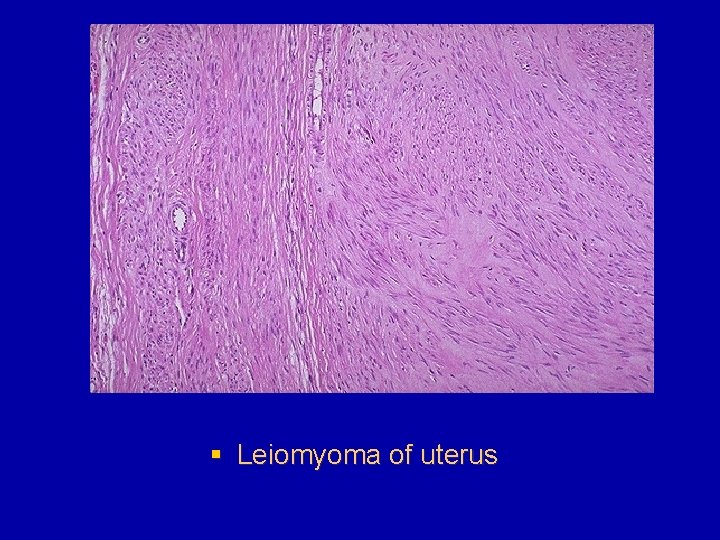 § Leiomyoma of uterus 