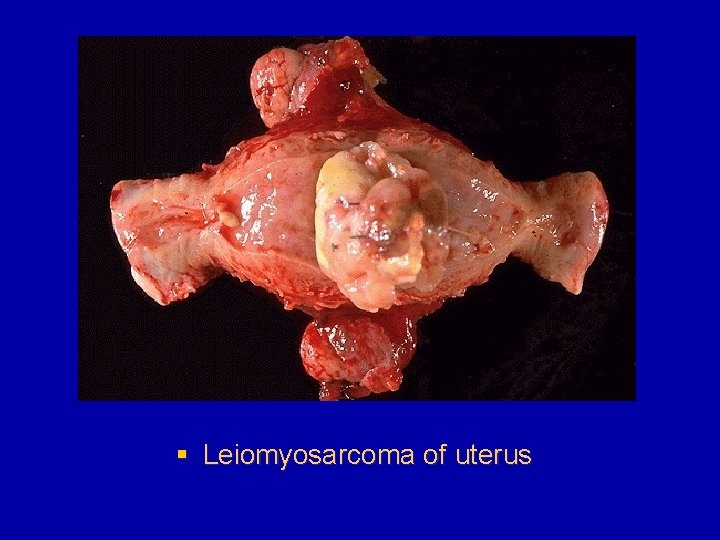 § Leiomyosarcoma of uterus 