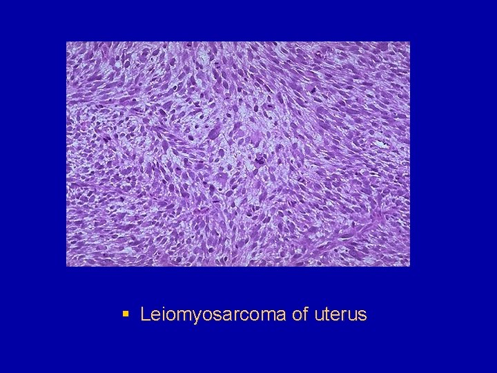 § Leiomyosarcoma of uterus 