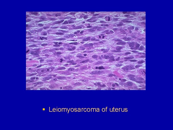 § Leiomyosarcoma of uterus 