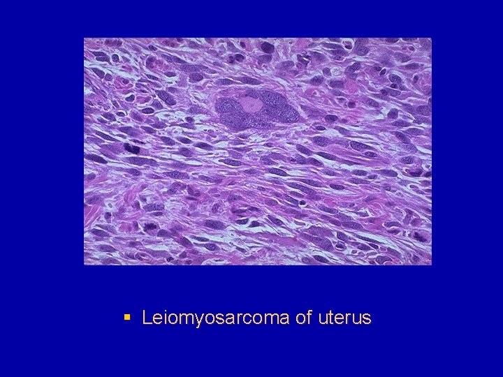§ Leiomyosarcoma of uterus 