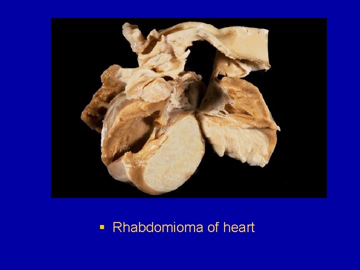 § Rhabdomioma of heart 