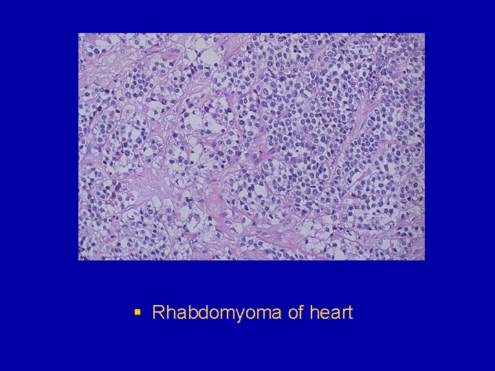 § Rhabdomyoma of heart 