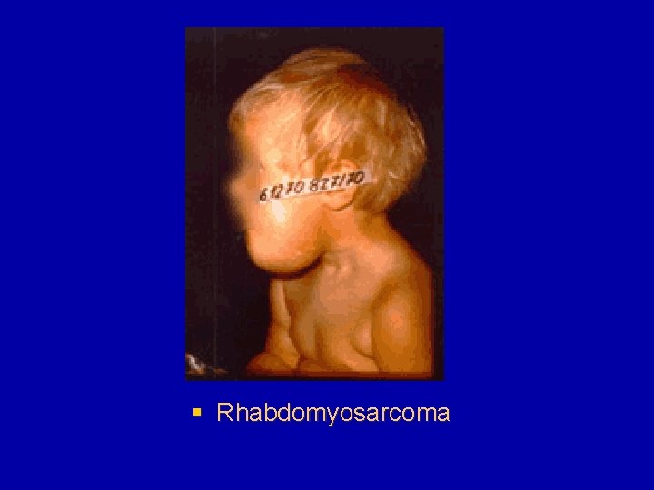 § Rhabdomyosarcoma 