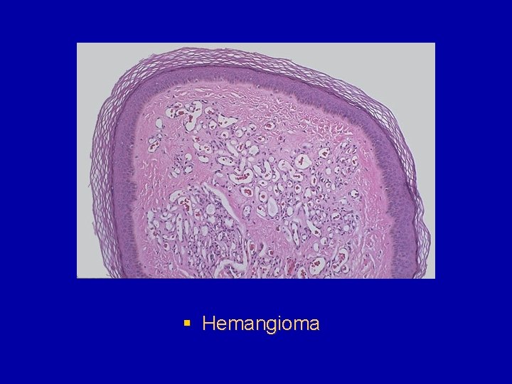 § Hemangioma 