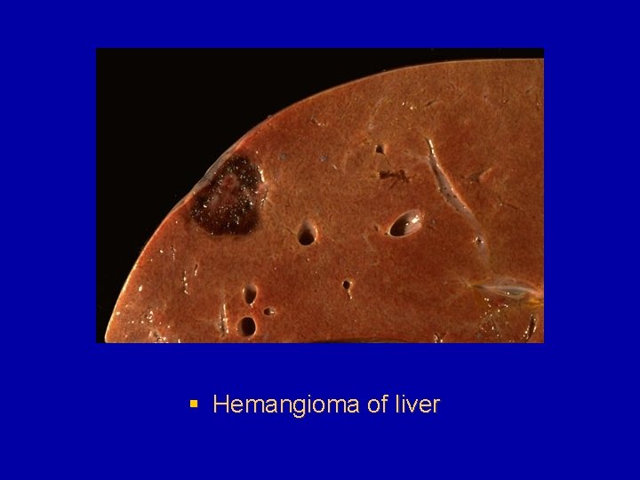 § Hemangioma of liver 