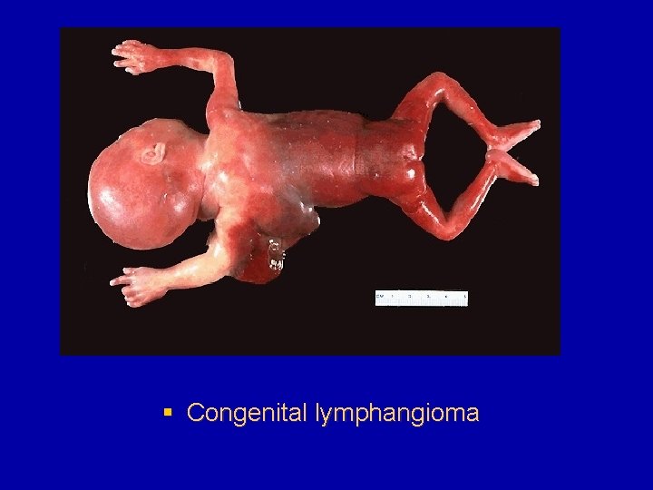 § Congenital lymphangioma 