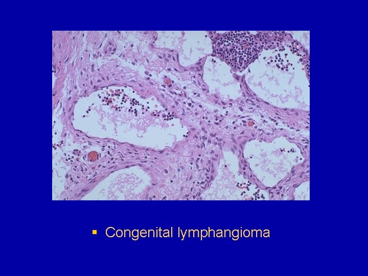 § Congenital lymphangioma 
