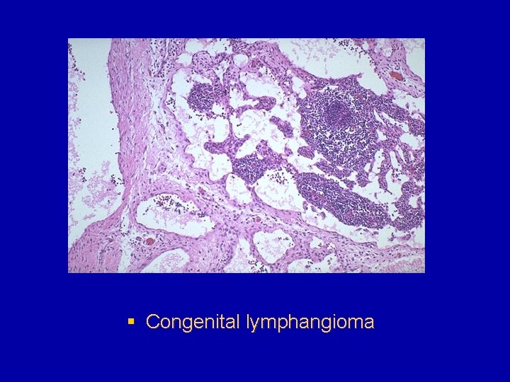 § Congenital lymphangioma 
