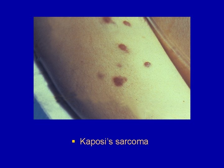 § Kaposi’s sarcoma 