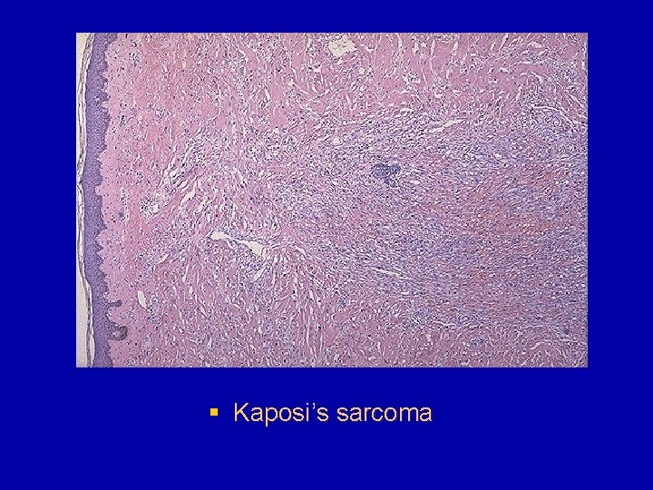§ Kaposi’s sarcoma 