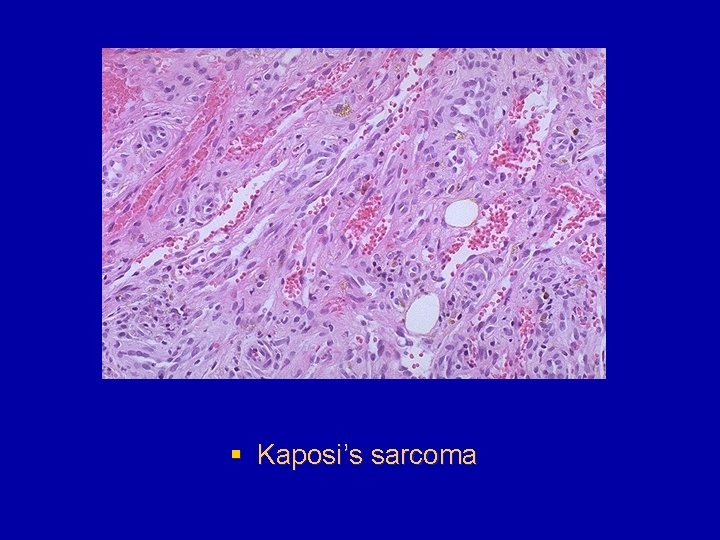 § Kaposi’s sarcoma 