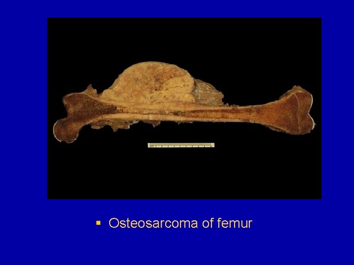§ Osteosarcoma of femur 