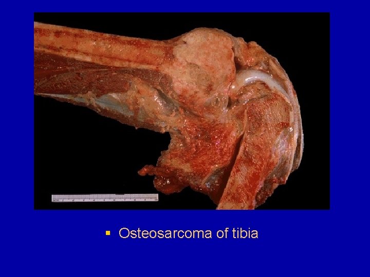 § Osteosarcoma of tibia 