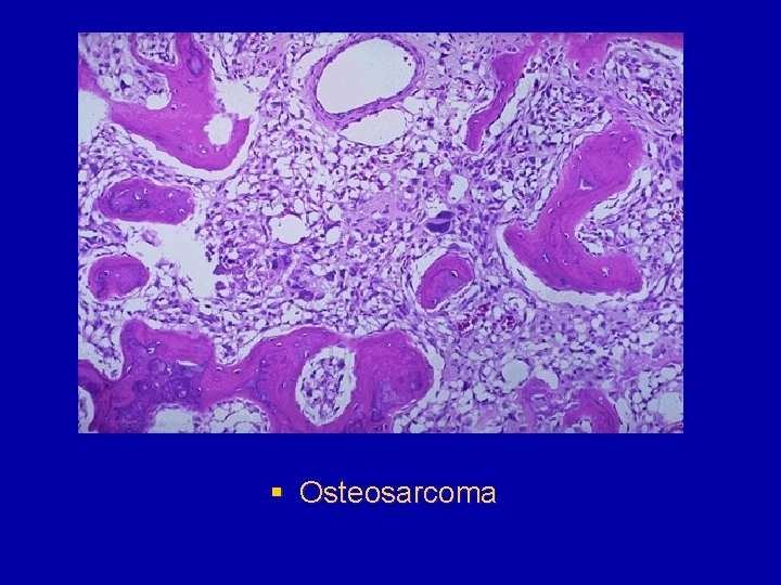 § Osteosarcoma 