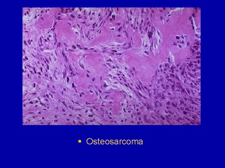 § Osteosarcoma 