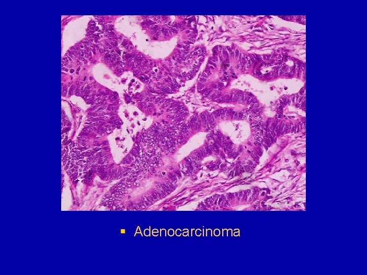 § Adenocarcinoma 