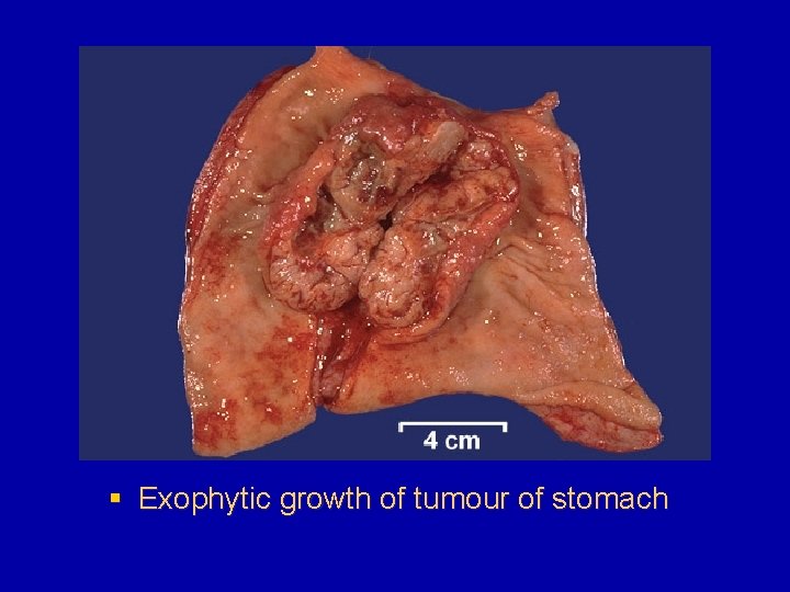 § Exophytic growth of tumour of stomach 