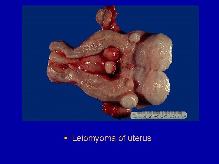 § Leiomyoma of uterus 