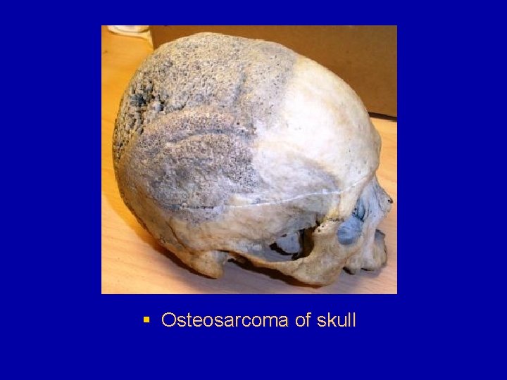 § Osteosarcoma of skull 
