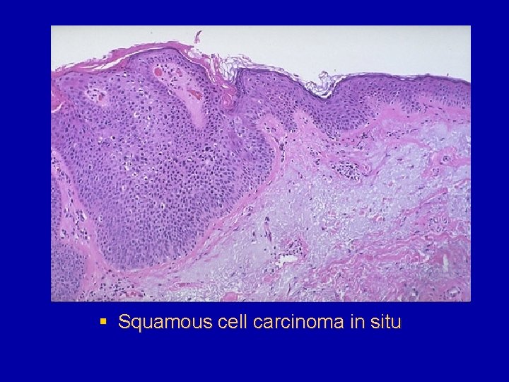 § Squamous cell carcinoma in situ 