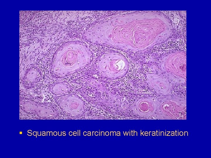 § Squamous cell carcinoma with keratinization 