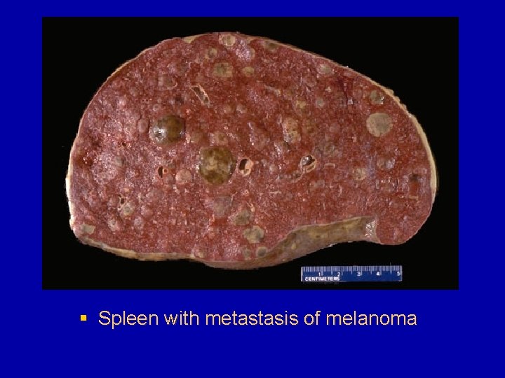 § Spleen with metastasis of melanoma 