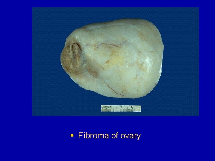§ Fibroma of ovary 