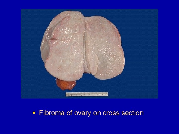 § Fibroma of ovary on cross section 