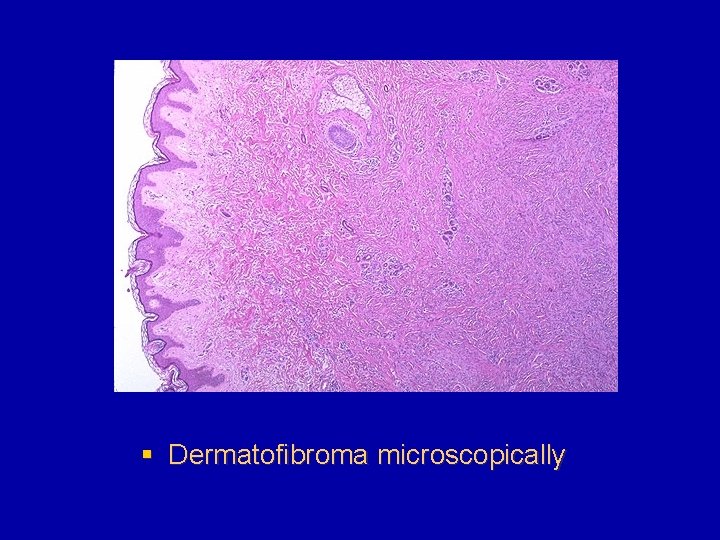 § Dermatofibroma microscopically 