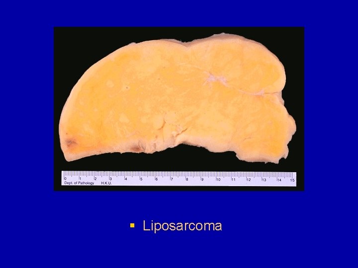 § Liposarcoma 