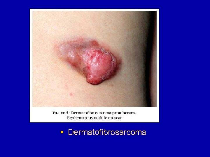 § Dermatofibrosarcoma 