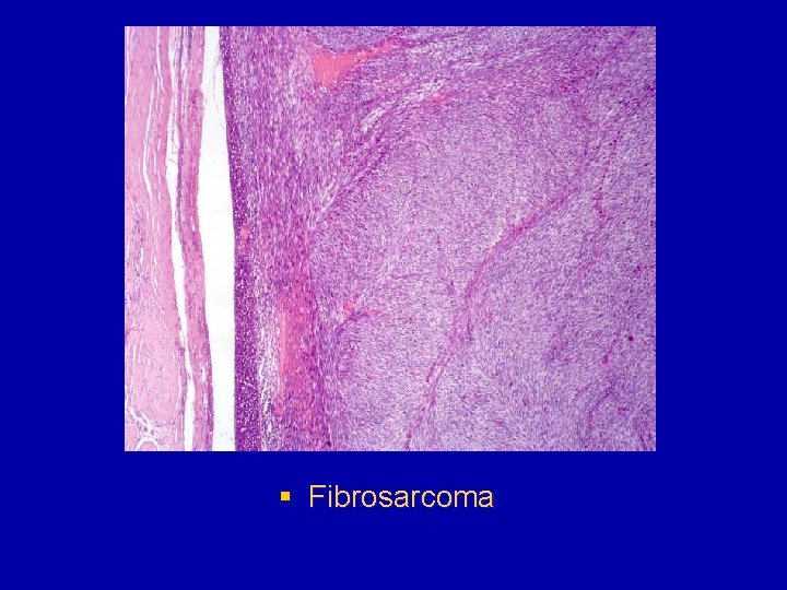 § Fibrosarcoma 