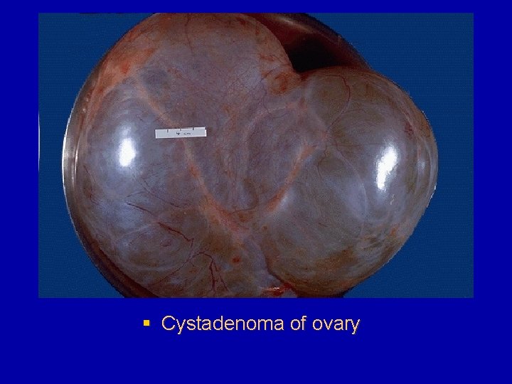 § Cystadenoma of ovary 