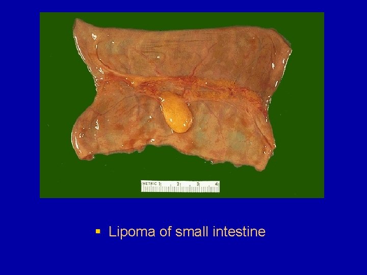 § Lipoma of small intestine 