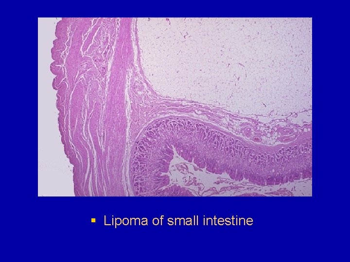 § Lipoma of small intestine 