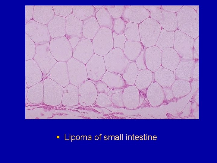 § Lipoma of small intestine 