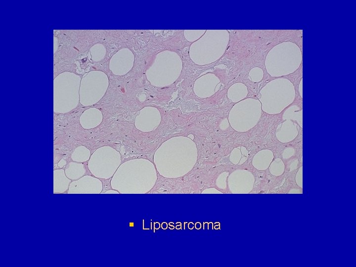 § Liposarcoma 