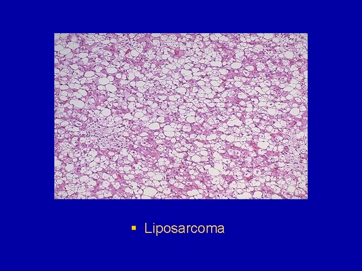 § Liposarcoma 