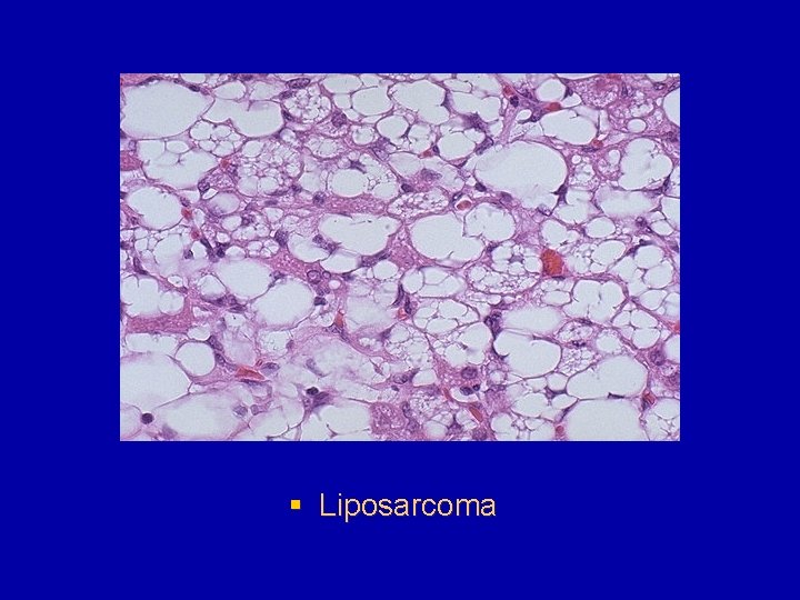 § Liposarcoma 