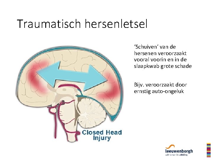 Traumatisch hersenletsel ‘Schuiven’ van de hersenen veroorzaakt vooral voorin en in de slaapkwab grote