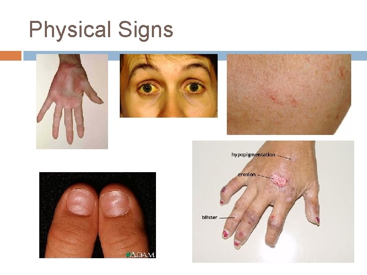 Physical Signs 